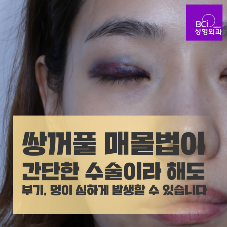 쌍꺼풀 매몰법 수술 후 시간에 따른 붓기 변화 - 중년눈성형 잘하는 비씨아이 - 눈매교정 눈성형의 모든것 - 비씨아이 성형외과 쌍꺼풀 매몰법 수술 후 시간에 따른 붓기 변화 - 중년눈성형 잘하는 비씨아이 - 눈매교정 눈성형의 모든것 - 비씨아이 성형외과