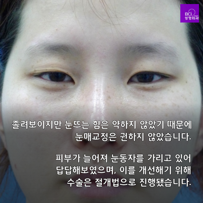 쌍꺼풀 절개법과 윗눈꺼풀 지방제거술을 소개합니다(쌍꺼풀 수술(쌍꺼풀 절개 + 앞트임)) 2