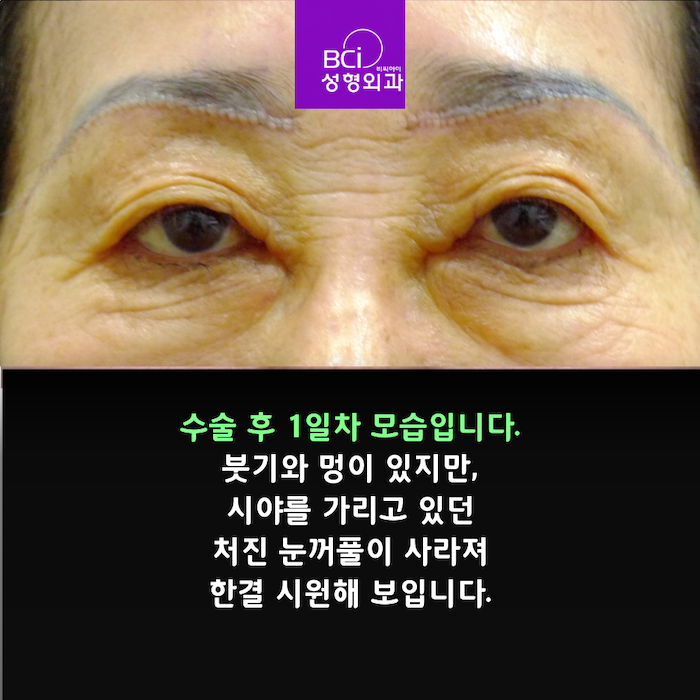 미하거수술 후 리뷰 비용 60대 눈꺼풀 처짐 꼬막눈 내금 내산